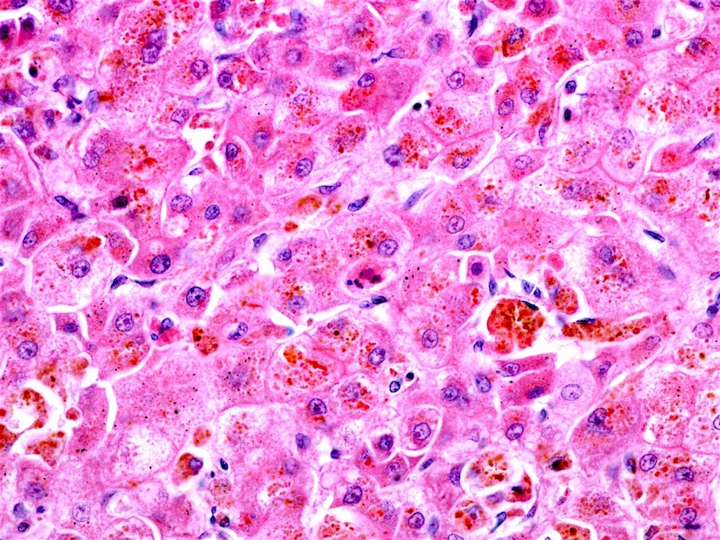 pathology-outlines-wilson-disease