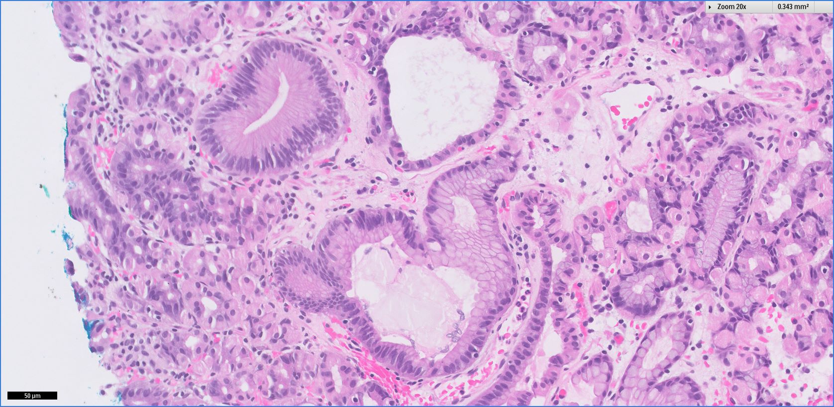 Pathology Outlines Fundic Gland Polyp