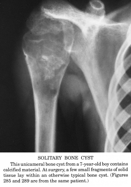 Pathology Outlines - Simple bone cyst