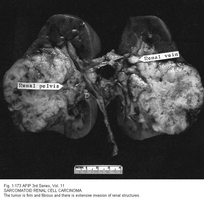 Renal Cell Carcinoma Stage 4 2012