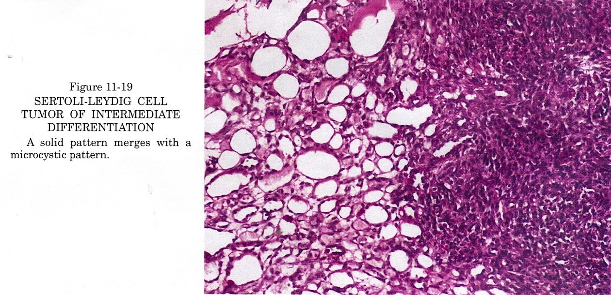 Pathology Outlines Sertoli Leydig Tumor