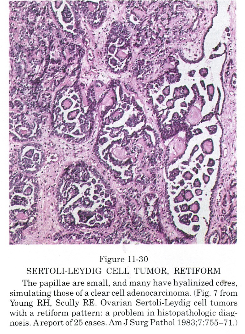 Pathology Outlines Sertoli Leydig Tumor