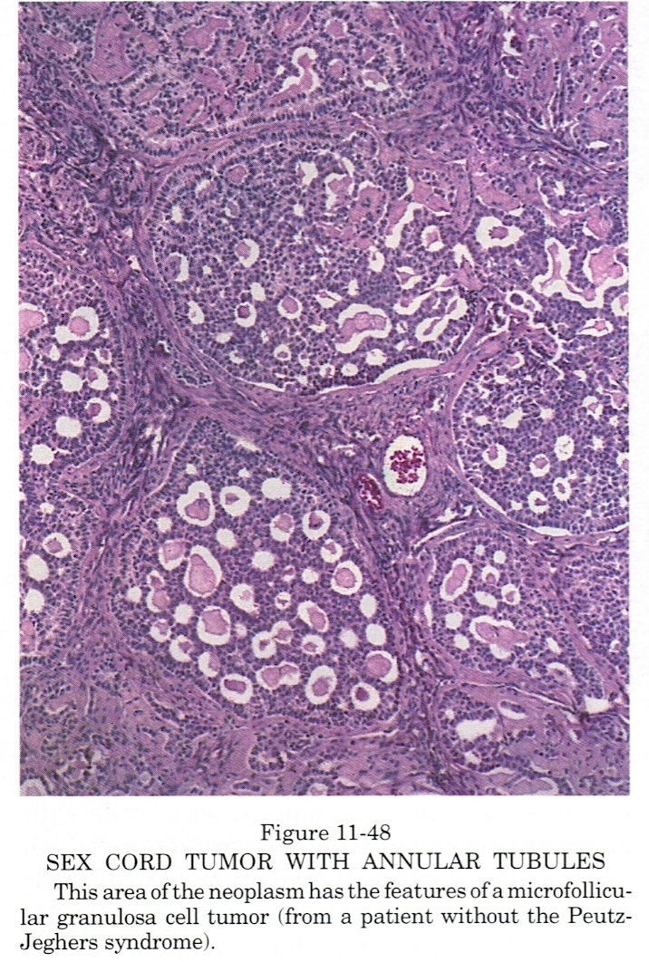 adult granulosa cell tumor