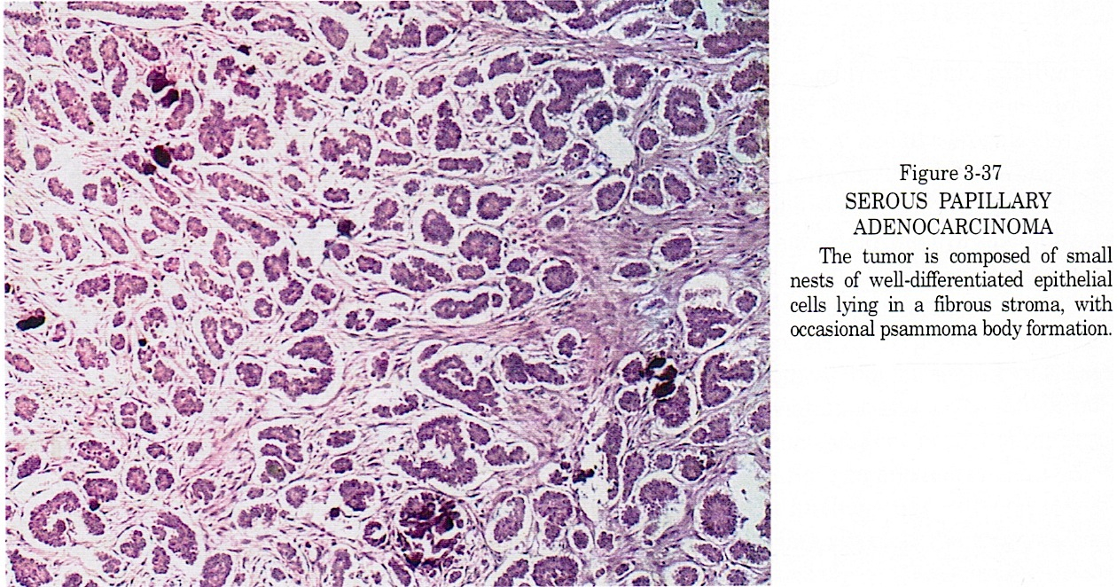 pathology-outlines-serous-carcinoma