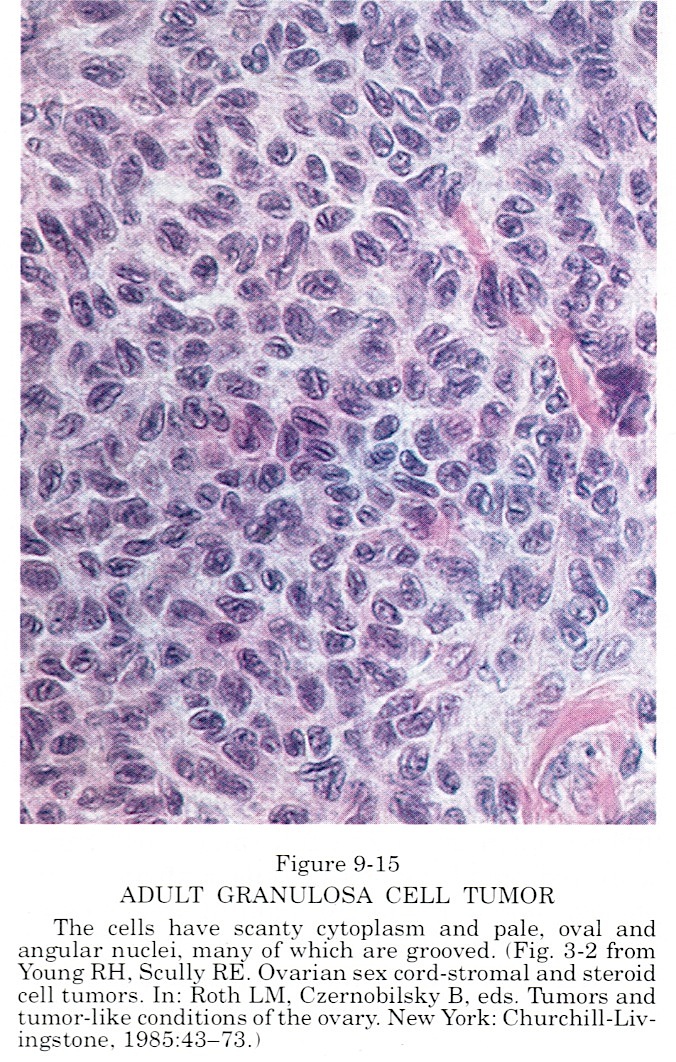 Granulosa cell tumor of ovary histopathology report