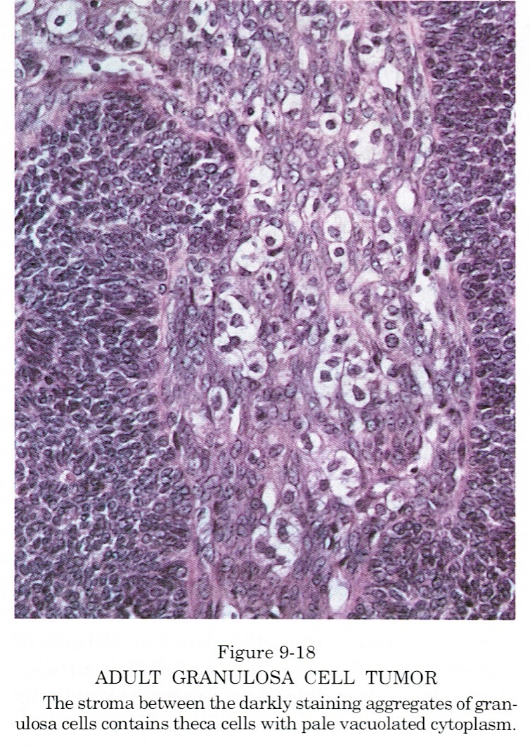 Pathology Outlines Granulosa Cell Tumor Adult