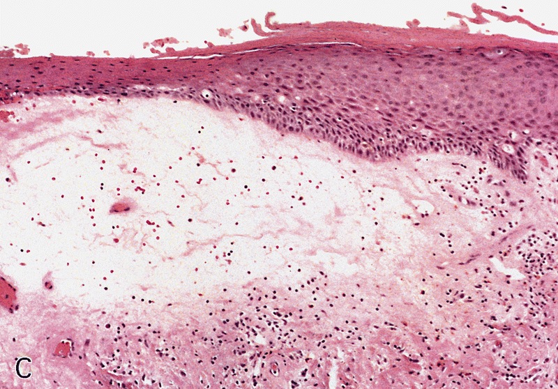 Pathology Outlines Lichen Sclerosus Balanitis Xerotica