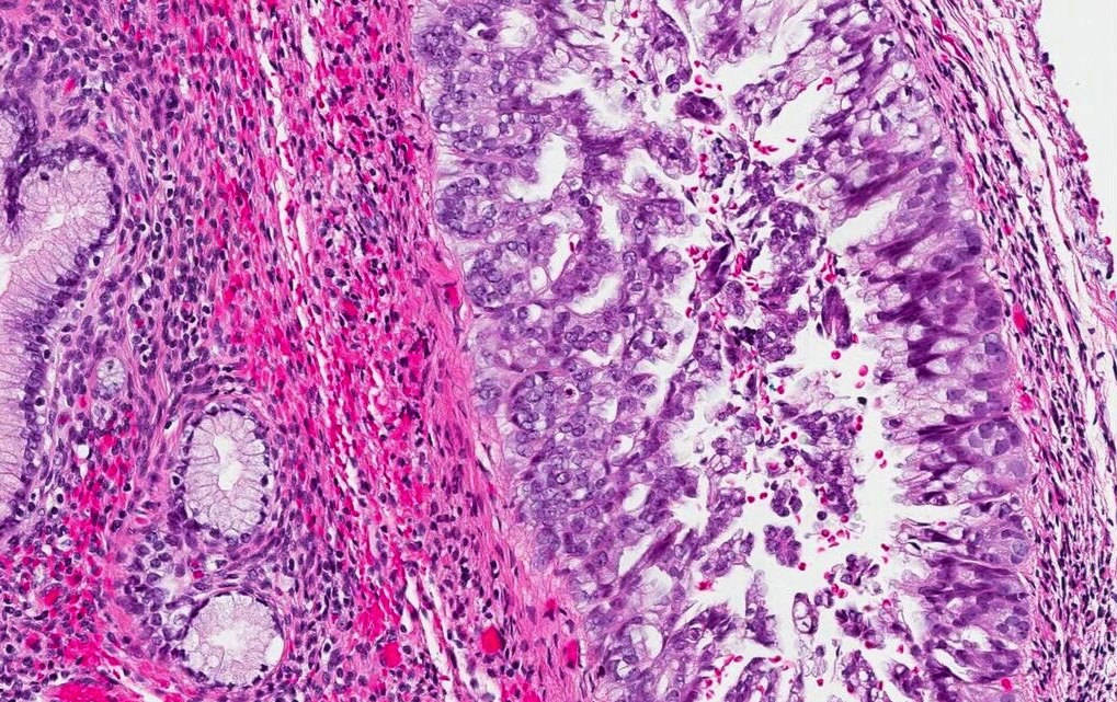 Pathology Outlines Gastric Type Adenocarcinoma 