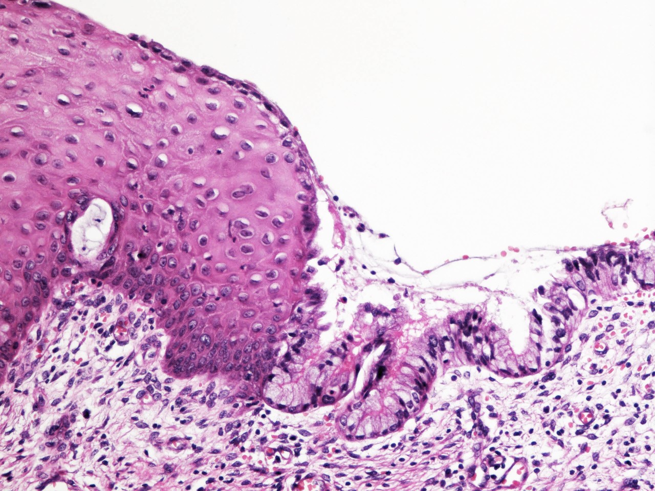 Pathology Outlines Squamous Metaplasia