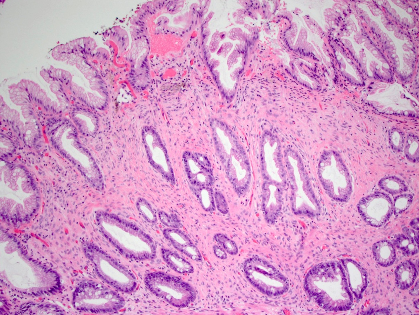 Pathology Outlines - Perineurioma