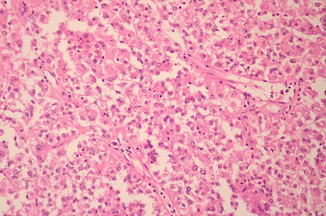 Pathology Outlines Epithelioid Angiomyolipoma