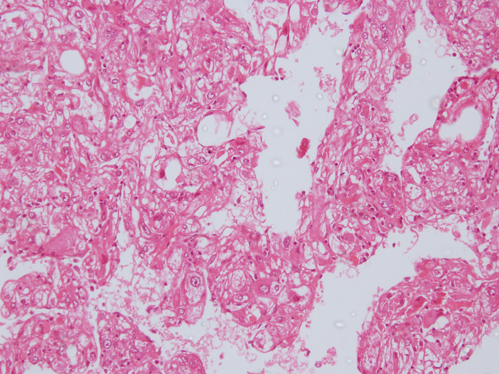 Pathology Outlines Hemangioma 8241