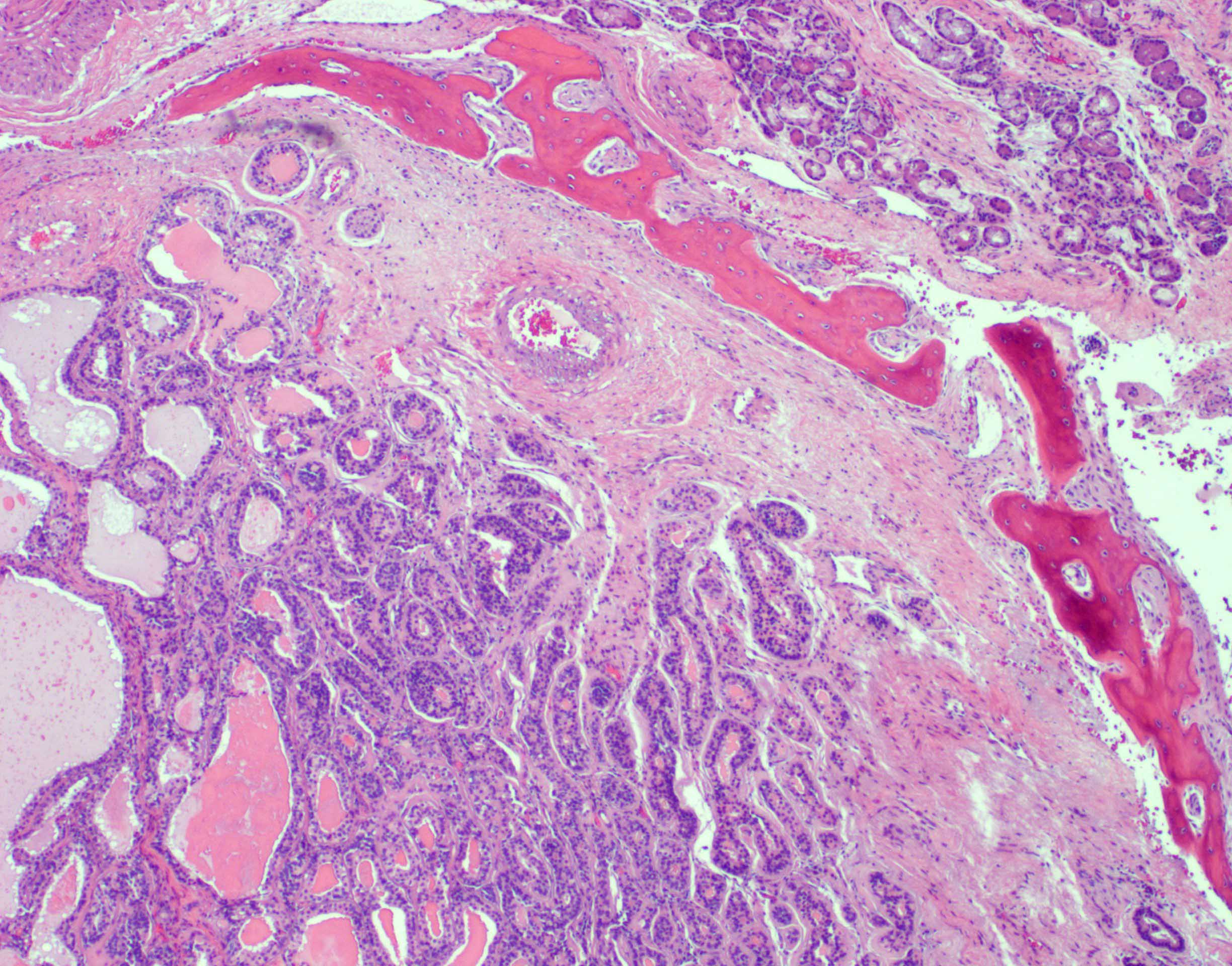 Pathology Outlines Adenocarcinoma General