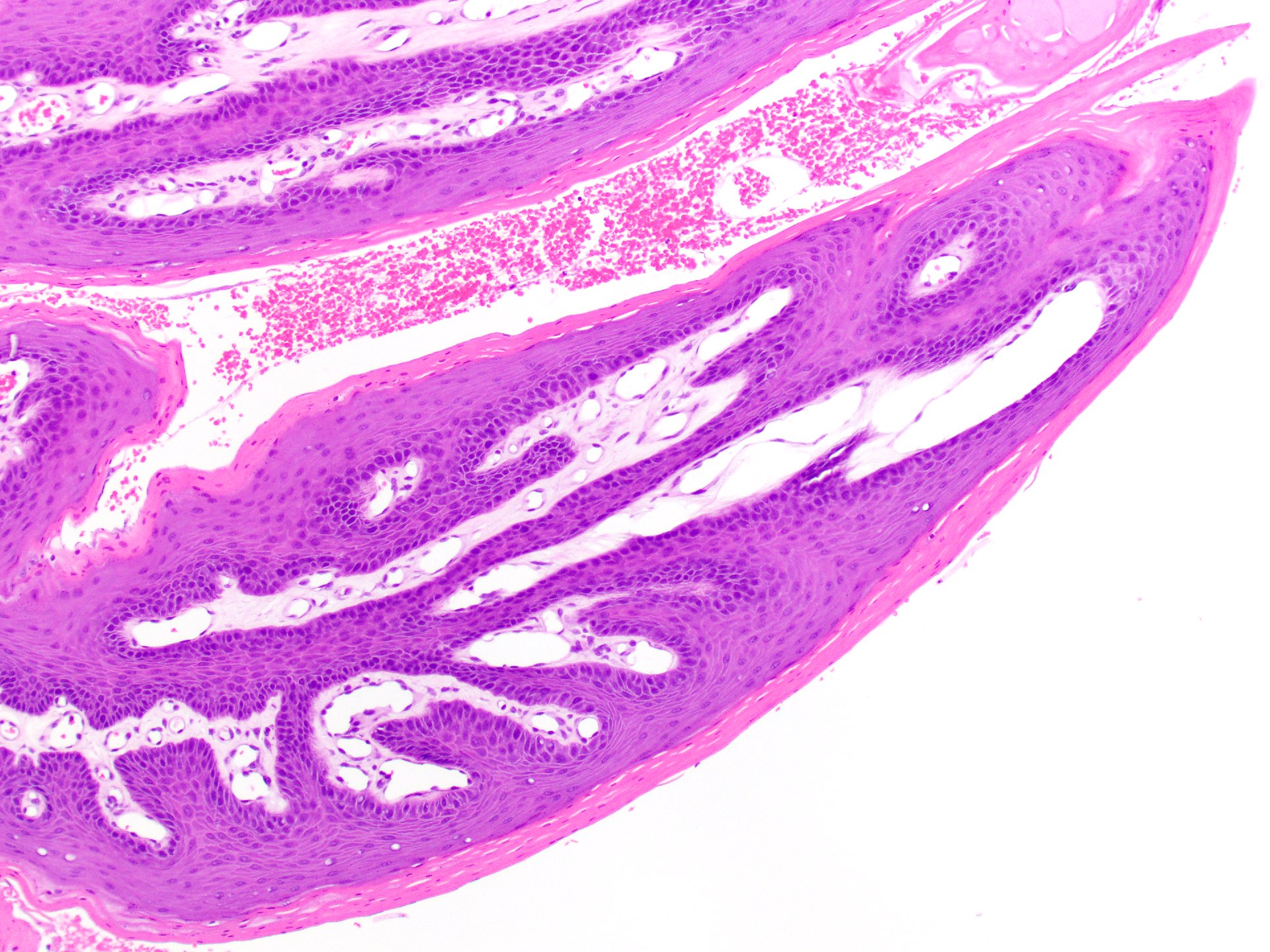 Pathology Outlines Squamous Papilloma