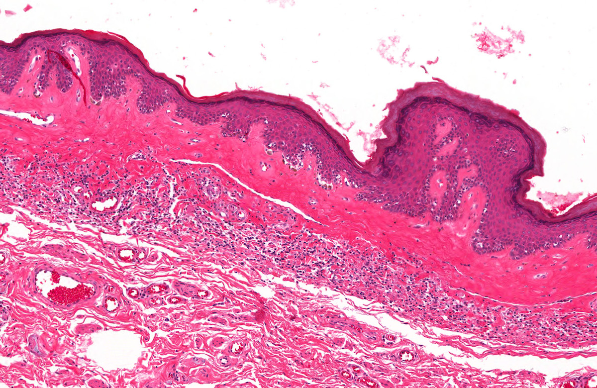 Pathology Outlines Lichen Sclerosus Balanitis Xerotica