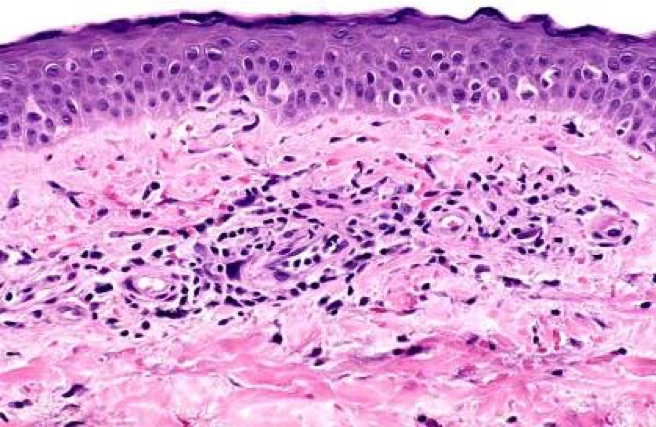 Pathology Outlines Pigmented Purpuric Dermatosis