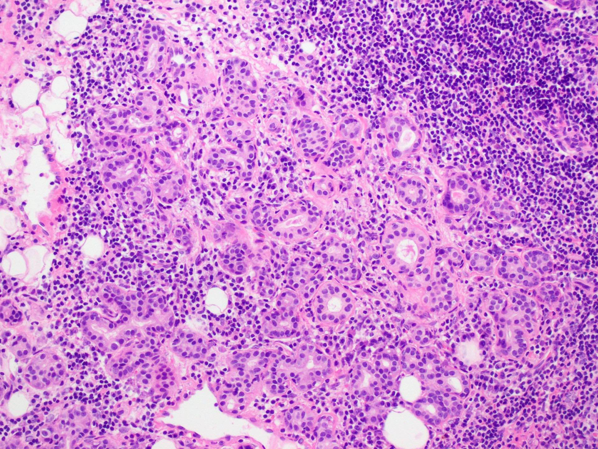 Pathology Outlines Sj Gren Syndrome