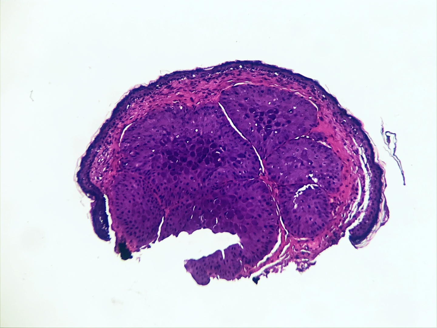 Pathology Outlines Molluscum Contagiosum