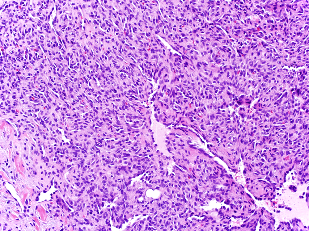 Pathology Outlines Acquired Tufted Angioma