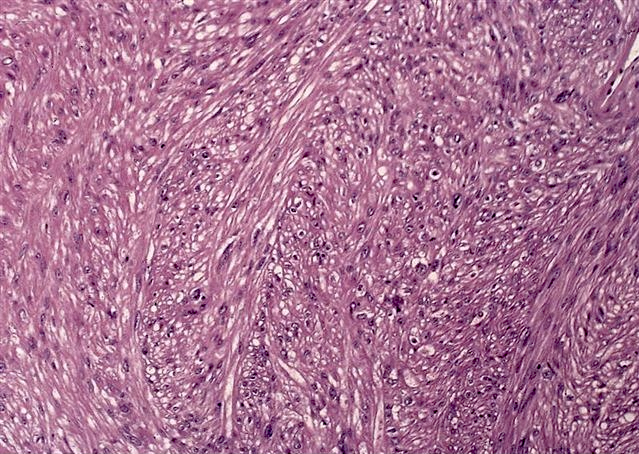 Pathology Outlines Leiomyoma