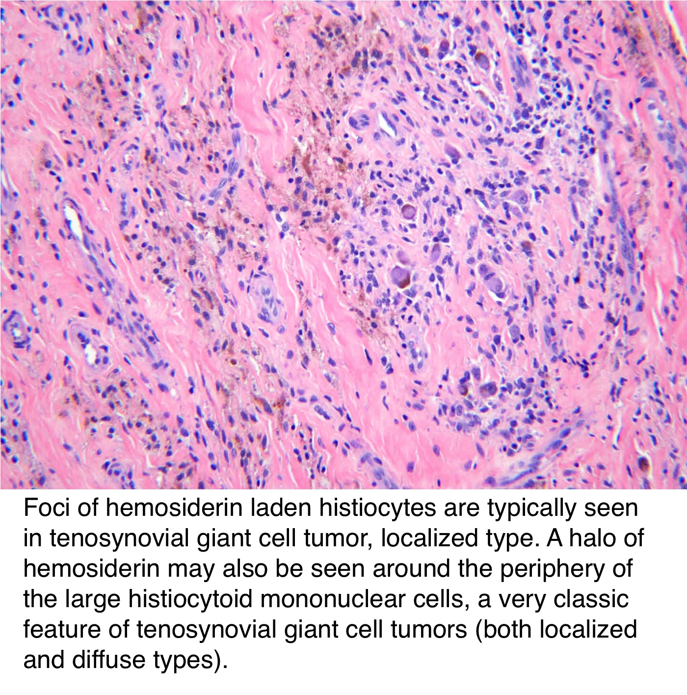 Pathology Outlines Tenosynovial Giant Cell Tumor Localized Type