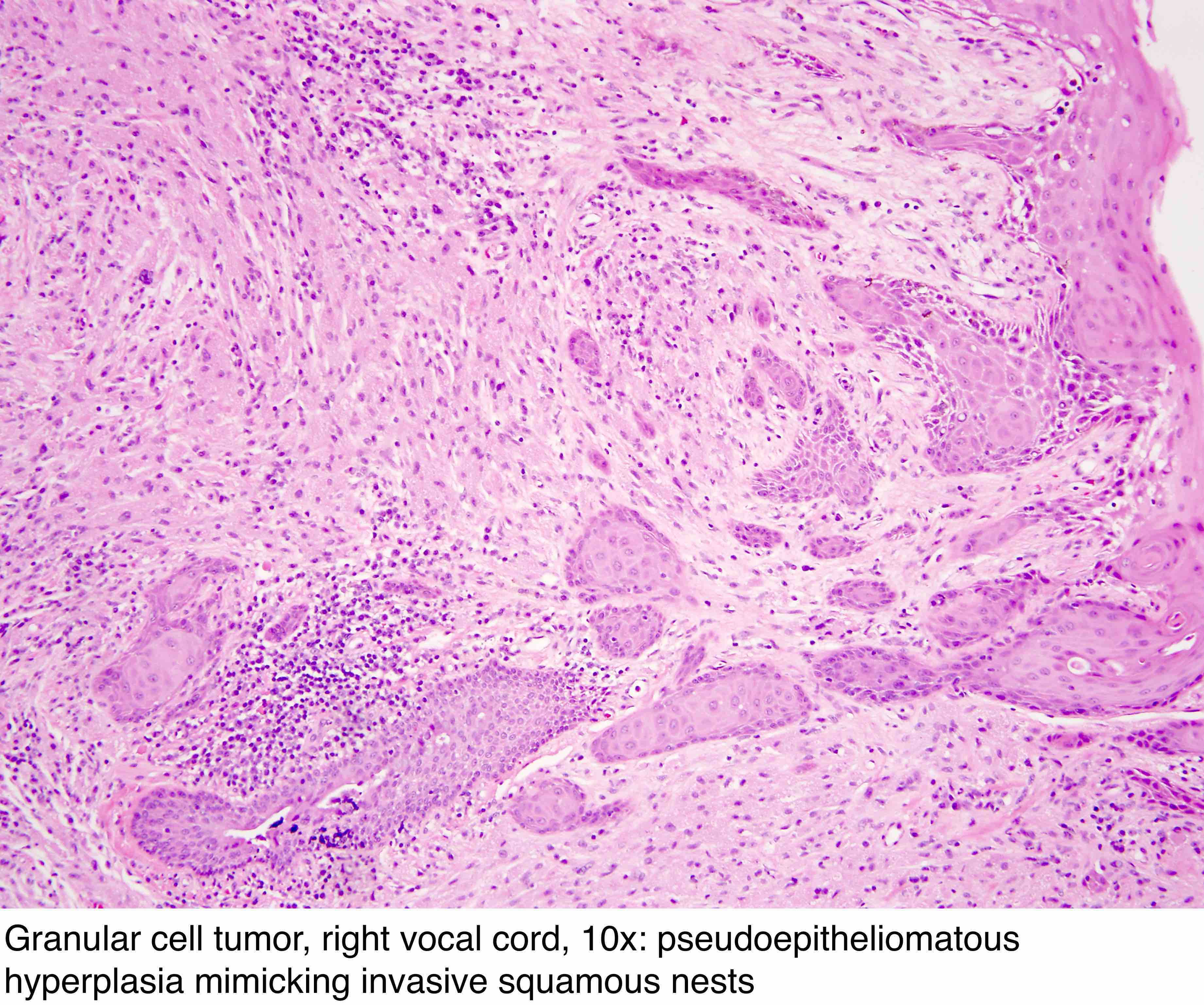 Pathology Outlines Granular Cell Tumor