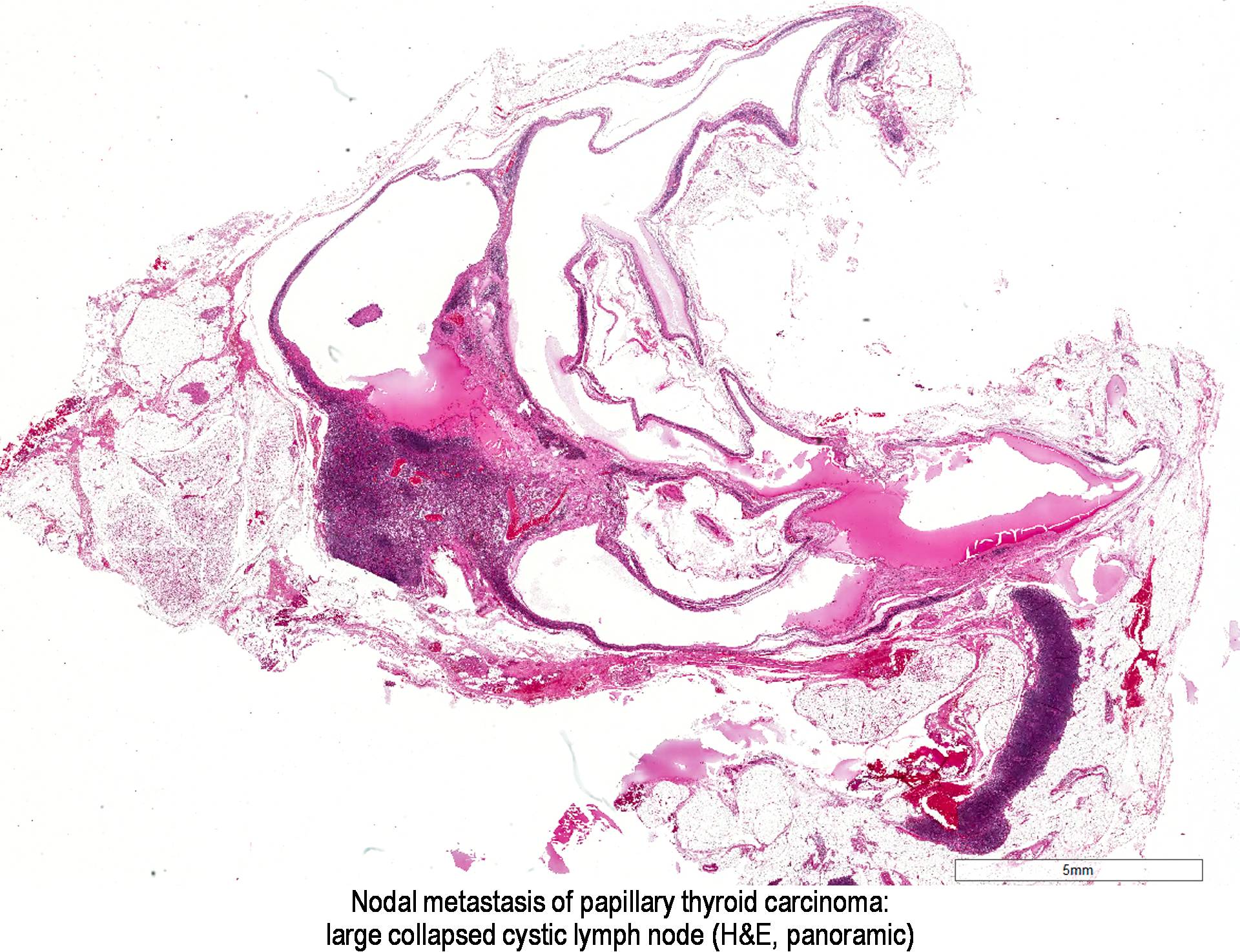 Pathology Outlines Papillary Thyroid Carcinoma Overview