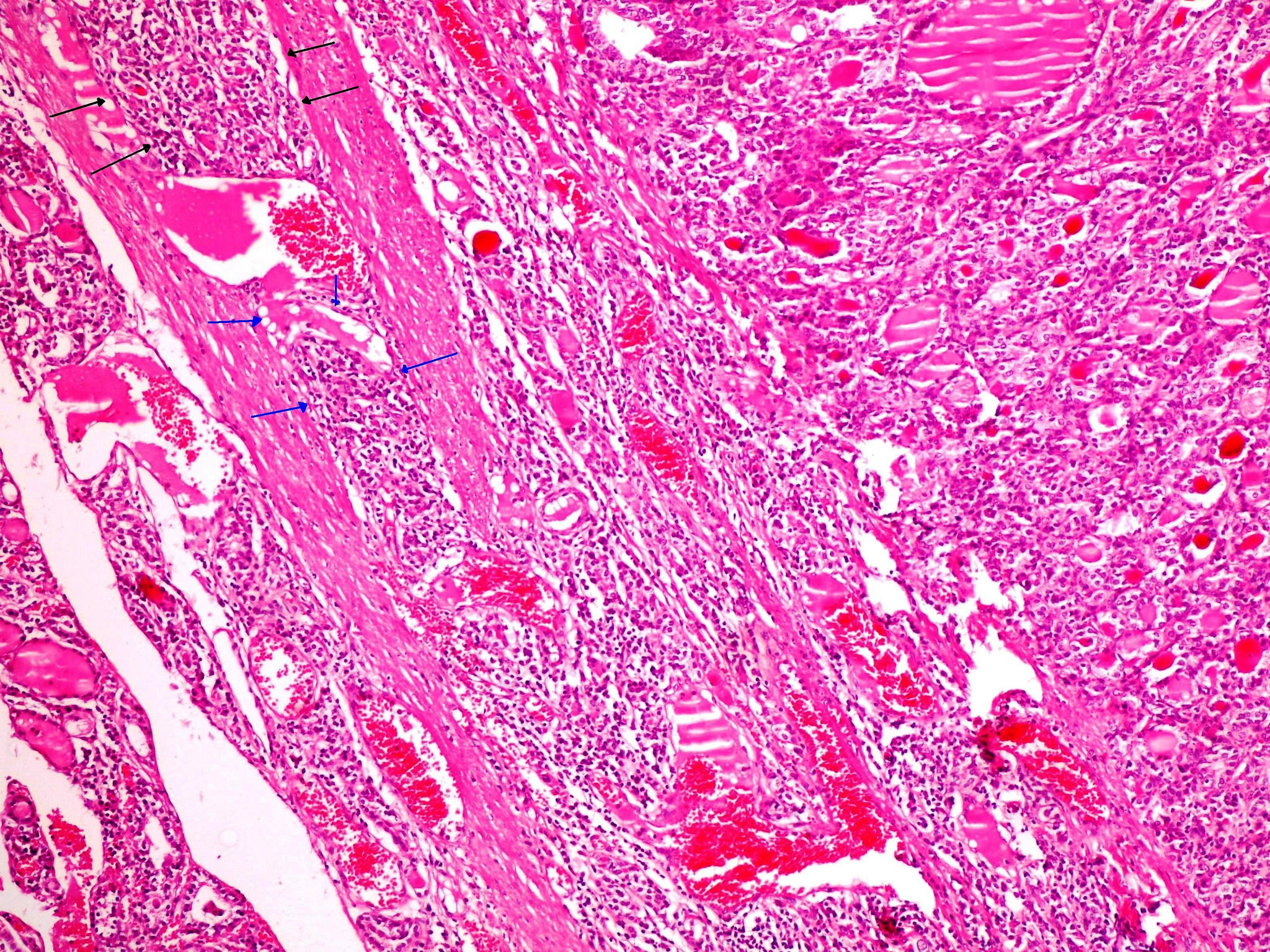 Pathology Outlines Follicular carcinoma