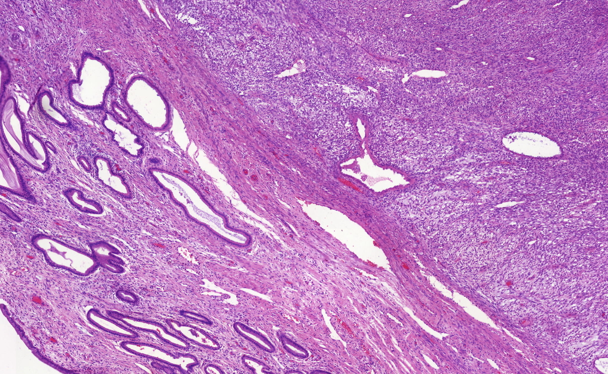 Pathology Outlines High Grade Endometrial Stromal Sarcoma