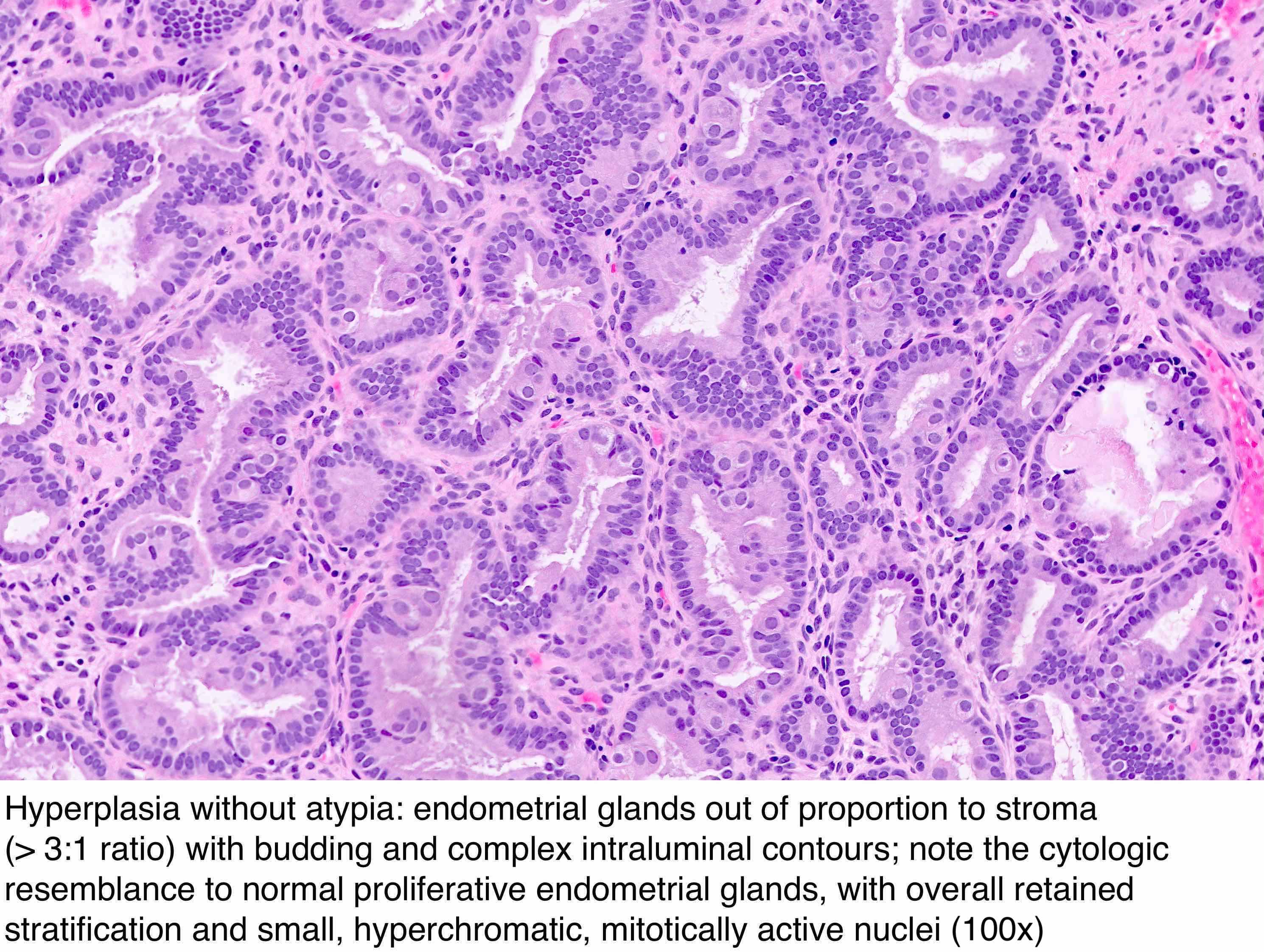 Pathology Outlines Endometrial Hyperplasia Endometrioid
