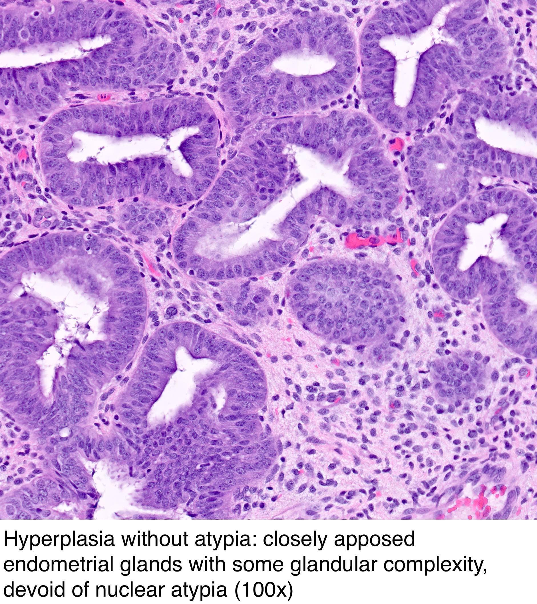 Pathology Outlines - Endometrial Hyperplasia / Endometrioid ...