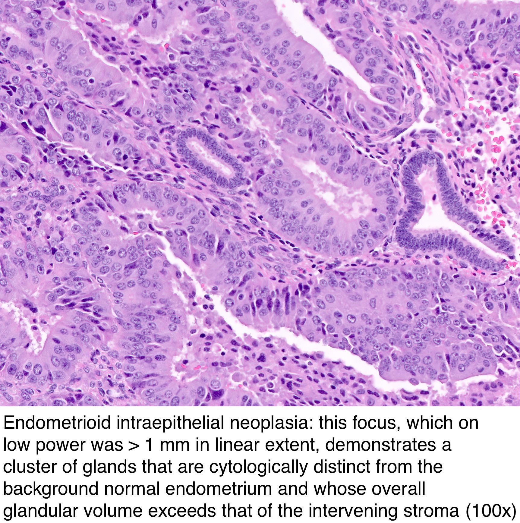 Pathology Outlines Endometrial Hyperplasia Endometrioid