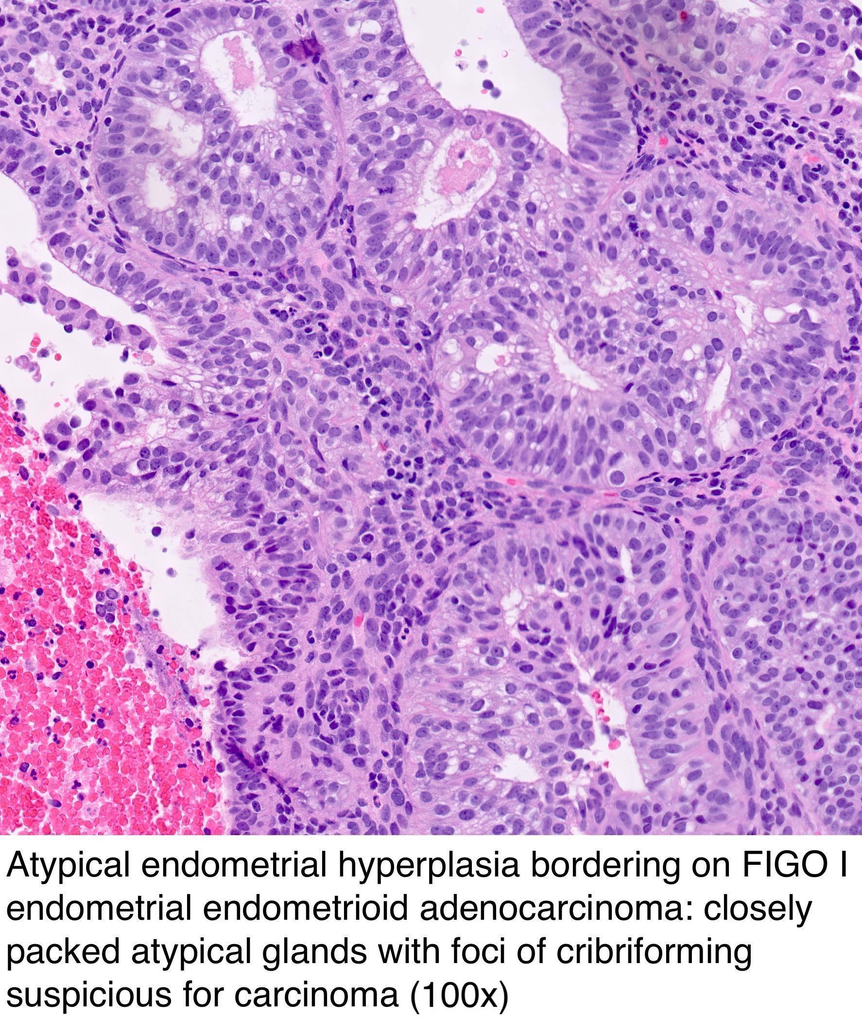 Pathology Outlines Endometrial Hyperplasia Endometrioid Intraepithelial Neoplasia Ein