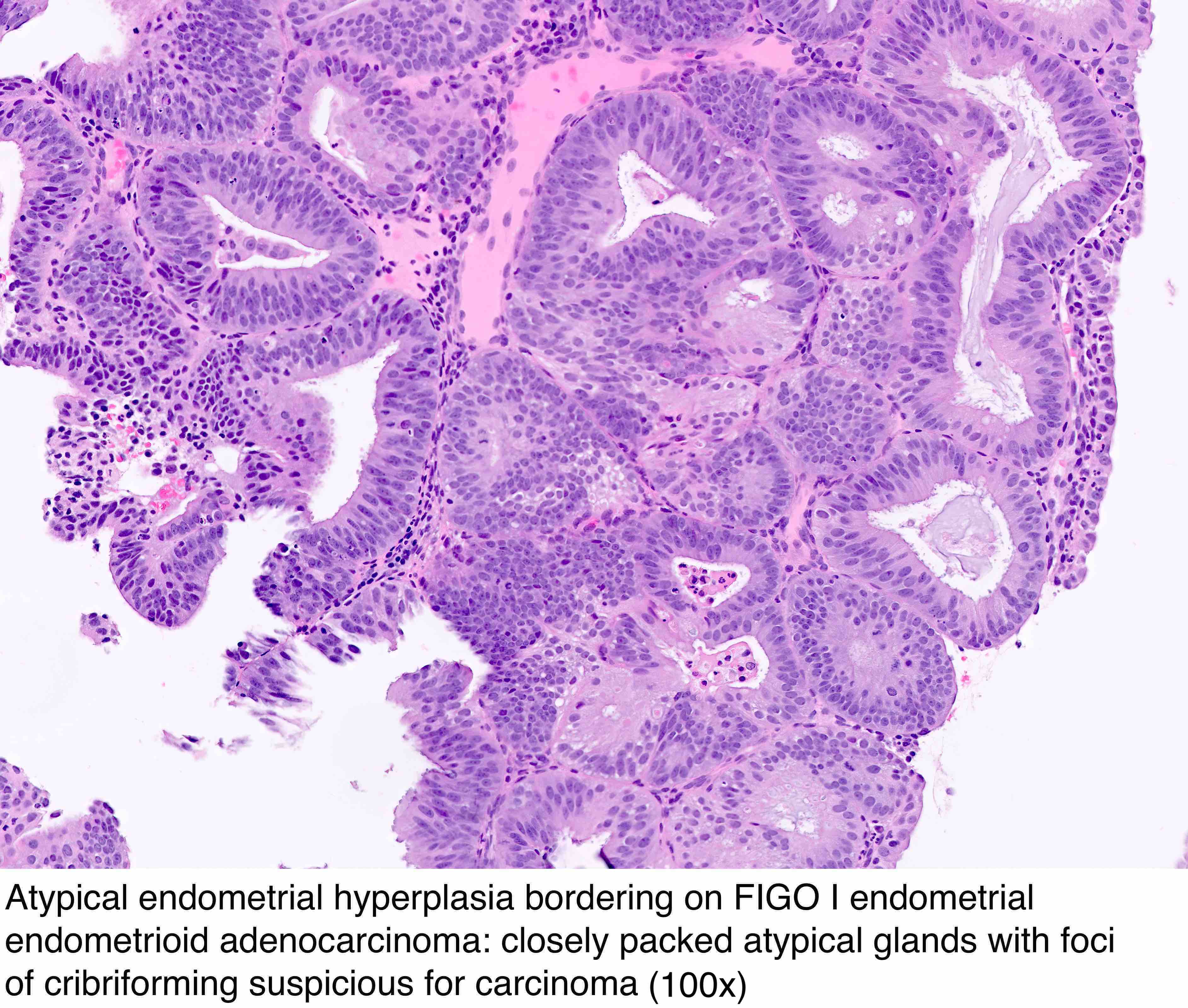 pathology-outlines-endometrial-hyperplasia-endometrioid