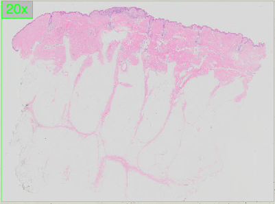 Pathology Outlines - Dysplastic Nevi