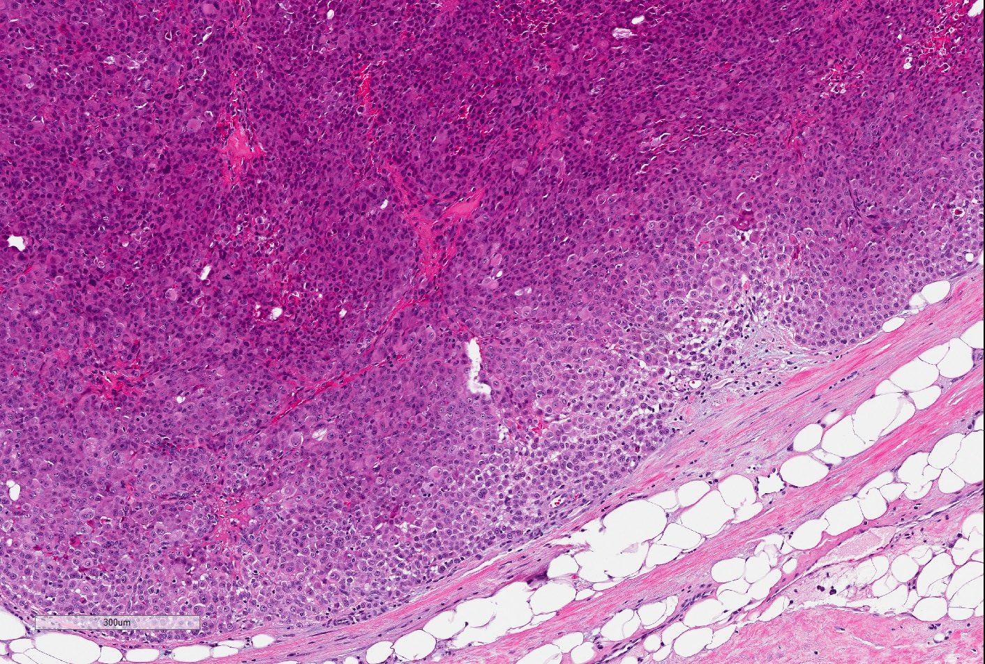 Pathology Outlines Epithelioid Sarcoma