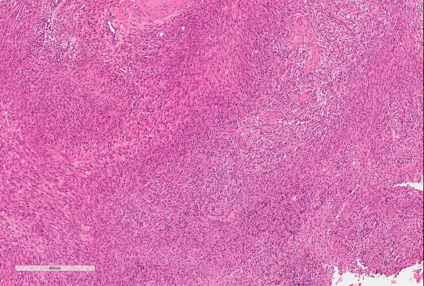 Pathology Outlines Epithelioid Sarcoma