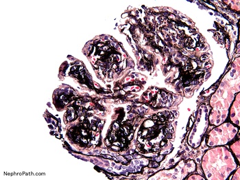 Pathology Outlines Membranoproliferative Glomerulonephritis Types I III