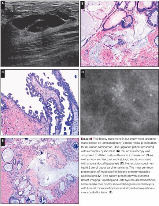 Pathology Outlines Mucocele Like Lesion Mll Of Breast