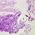 Pathology Outlines Herpes Simplex Esophagitis