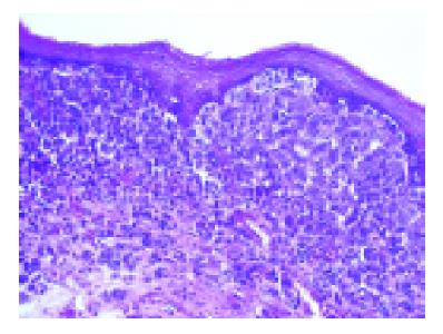 melanoma esophageal