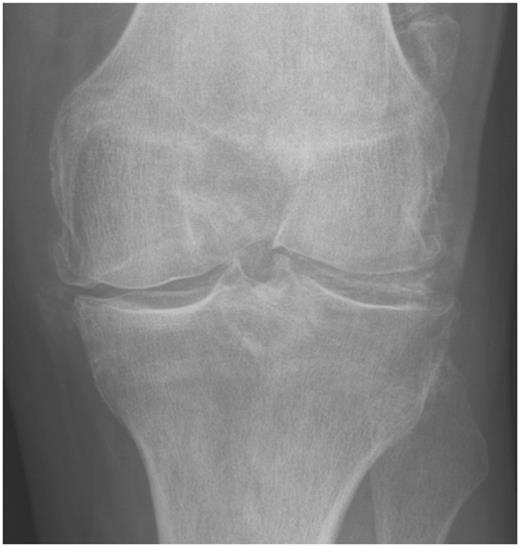 Pathology Outlines - Calcium Pyrophosphate Crystal Deposition Disease