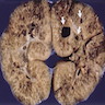 Pathology Outlines - Autosomal Recessive Polycystic Kidney Disease (arpkd)