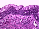 Pathology Outlines - Benign Brenner Tumor