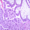 Pathology Outlines - Complete Hydatidiform Mole