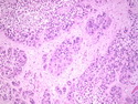 Pathology Outlines Epithelioid Trophoblastic Tumor