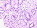 Pathology Outlines - Grading (Gleason)