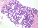 Pathology Outlines - Grading (Gleason)