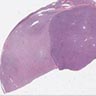 YWHAE::NUTM2A/B high grade endometrial stromal sarcoma