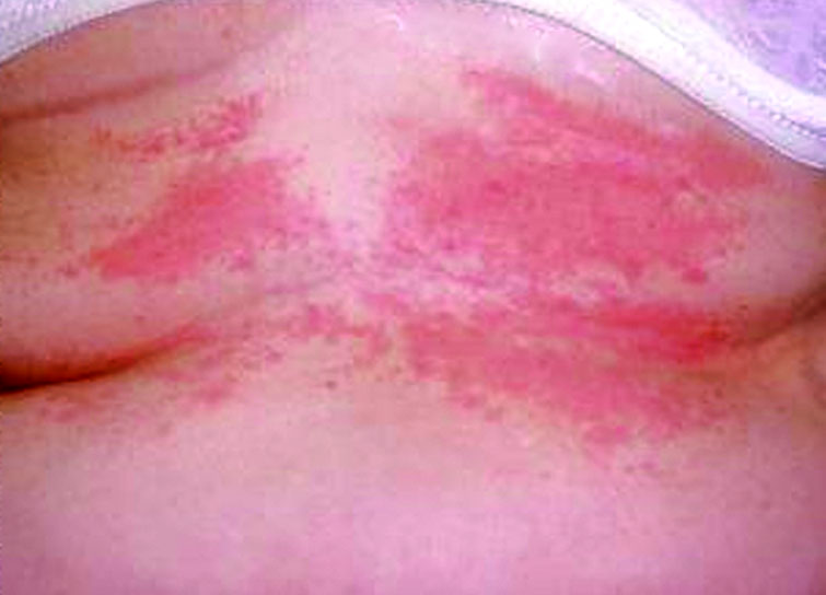 Irritant & Allergic Contact Dermatitis | Cleveland Clinic